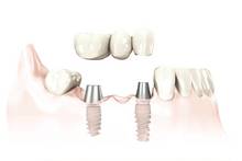 Zahnersatz auf Implantaten für zahnlose Patienten